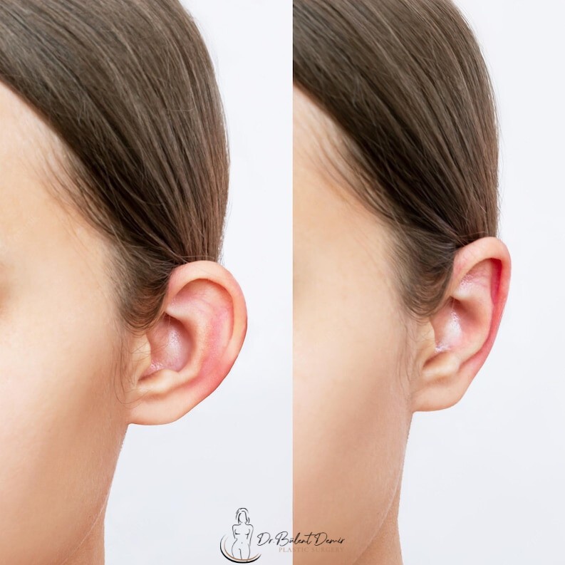 otoplasty-ear aesthetics Otoplasty (Ear Surgery) in Antalya,Turkey